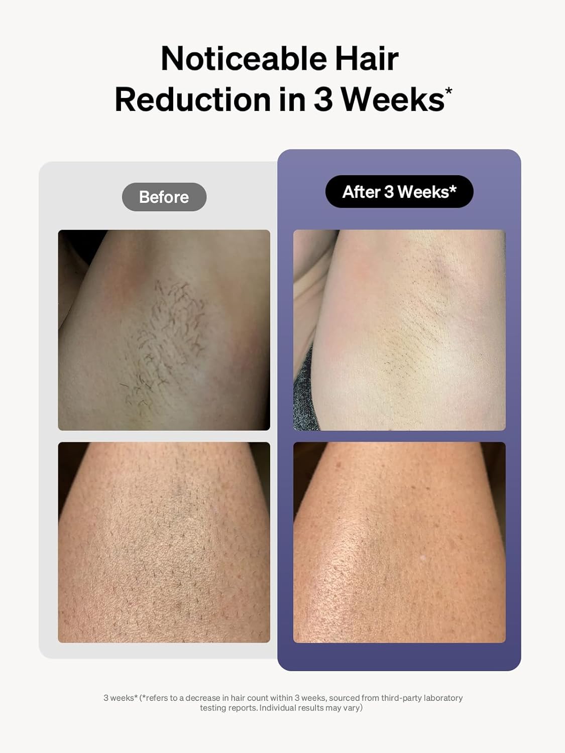 Ulike Laser Hair Removal for Women and Men, Air 3 Ice-cooling IPL Device Hair Removal for Nearly Painless & Long-Lasting Results, 3 Modes & Auto Flashing for Fast Full Body Hair Removal From Home